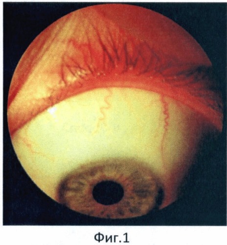 Способ исследования кровообращения переднего сегмента глаза (патент 2403857)