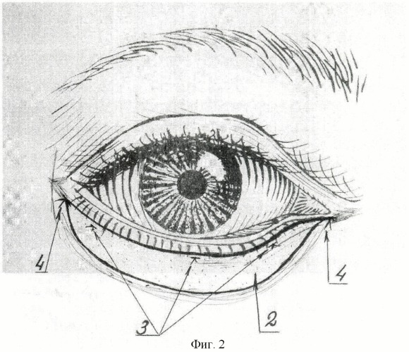 Способ укрепления нижнего века (патент 2445049)
