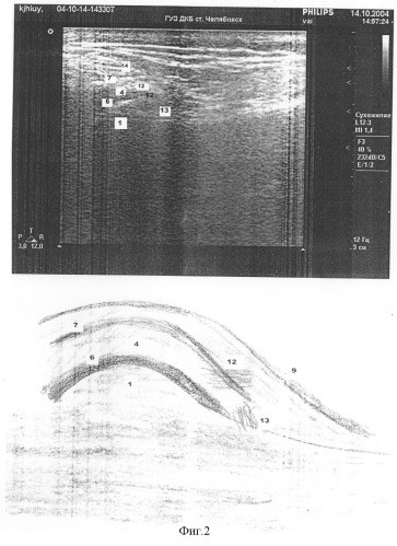 Способ ультразвукового исследования состояния диска височно-нижнечелюстного сустава (патент 2292842)