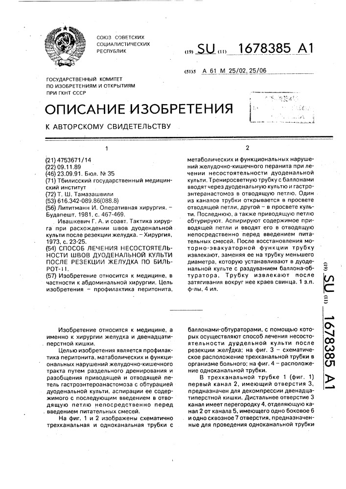 Способ лечения несостоятельности швов дуоденальной культи после резекции желудка по бильрот-11 (патент 1678385)