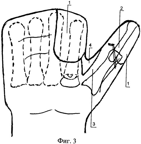 Способ формирования пальца кисти (патент 2460487)