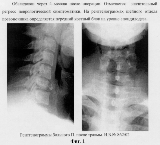 Способ переднего спондилодеза (патент 2254084)