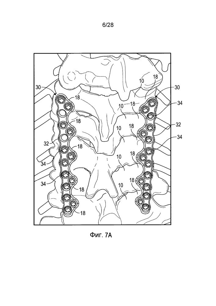 Система для задней фиксации позвоночника пластиной (патент 2605147)