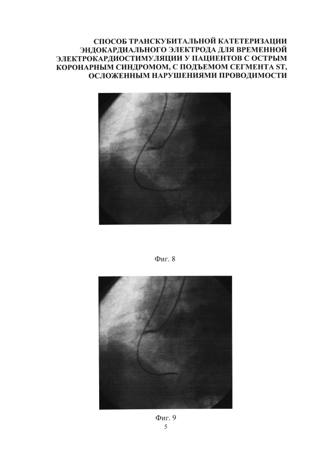 Способ катетеризации сердца для установки эндокардиального электрода для временной электрокардиостимуляции у пациентов с острым коронарным синдромом, с подъемом сегмента st, осложенным нарушениями проводимости (варианты) (патент 2594243)