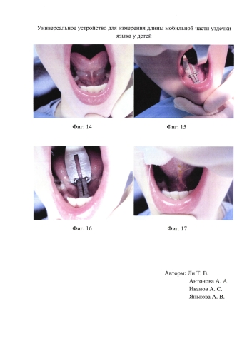 Универсальное устройство для измерения длины части уздечки языка у детей (патент 2584138)