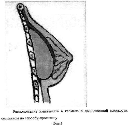 Способ формирования кармана для имплантата в двойственной плоскости при аугментационной маммопластике (патент 2498777)
