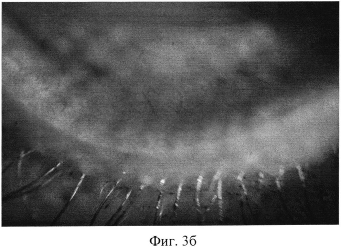 Способ оценки морфофункционального состояния мейбомиевых желез - биометрия мейбомиевых желез (патент 2567829)
