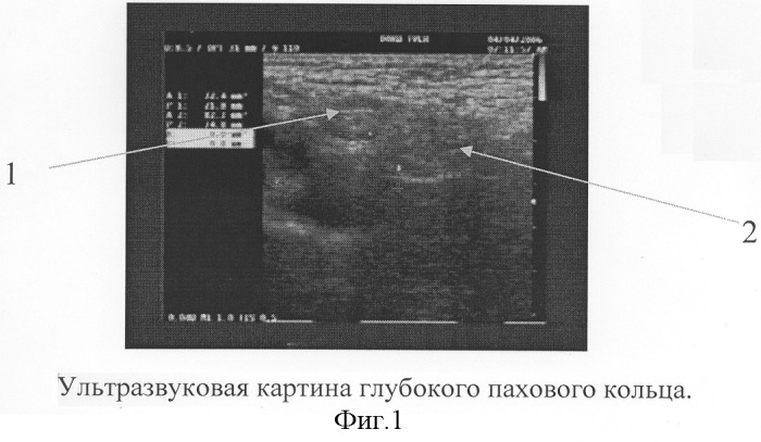 Способ определения показаний к выбору метода оперативного лечения паховых грыж у детей (патент 2303409)