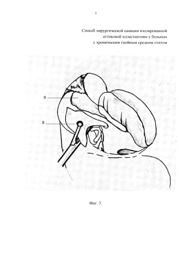 Способ хирургической санации изолированной аттиковой холестеатомы у больных с хроническим гнойным средним отитом (патент 2580041)