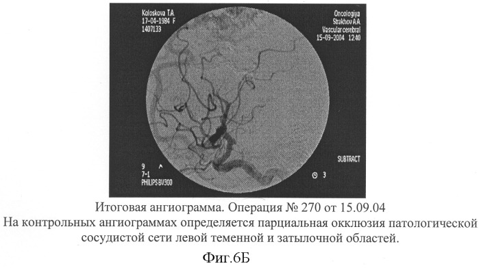 Способ эмболизации артериовенозных мальформаций головного мозга в условиях общей анестезии и управляемой гипотонии (патент 2315634)