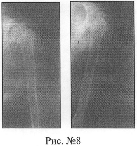 Способ хирургического лечения переломо-вывихов проксимального отдела плечевой кости напряженными спицами (патент 2483688)