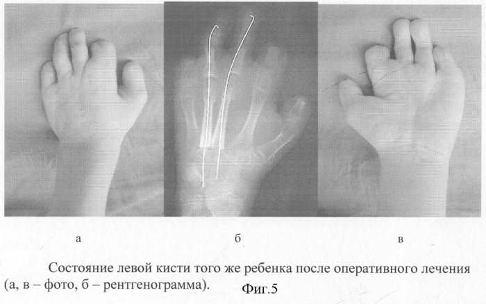 Способ реконструкции пальцев кисти у детей с последствиями травмы (патент 2278630)