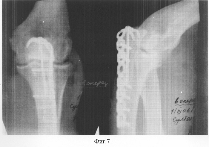 Способ лечения многооскольчатых переломов локтевой кости (патент 2306892)