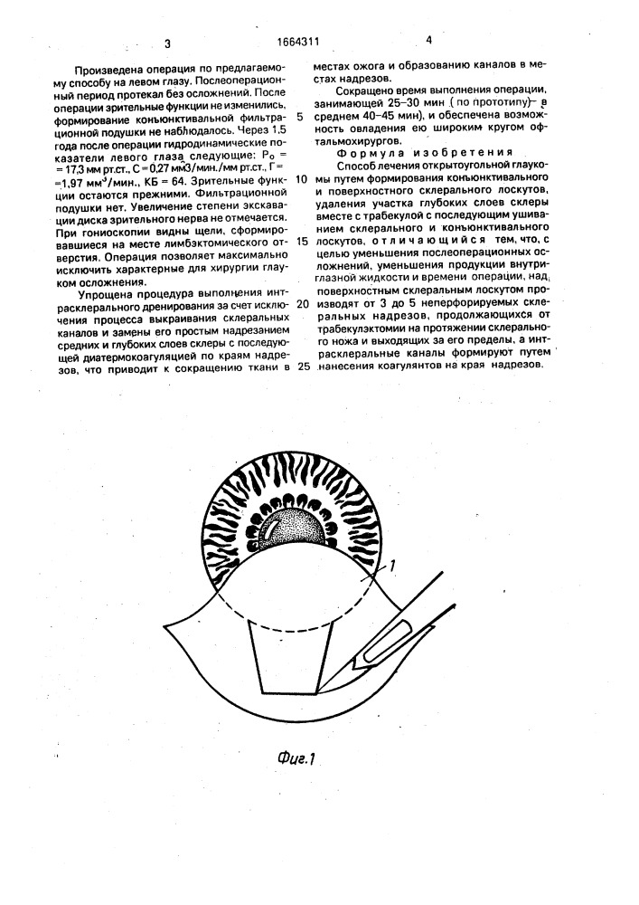 Способ лечения открытоугольной глаукомы (патент 1664311)