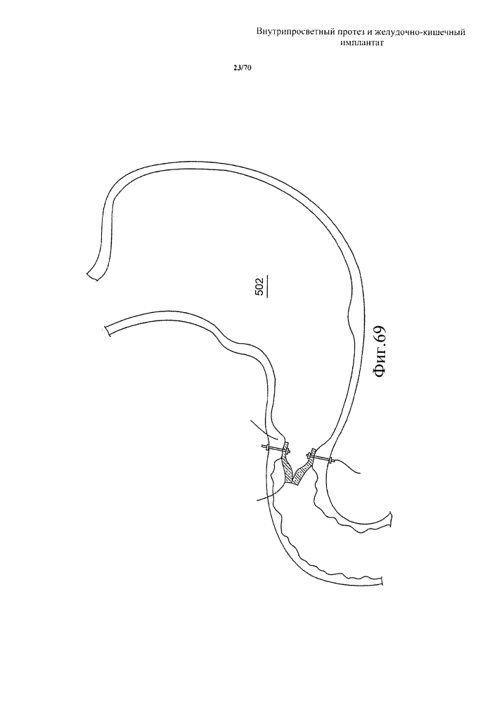 Внутрипросветный протез и желудочно-кишечный имплантат (патент 2626885)