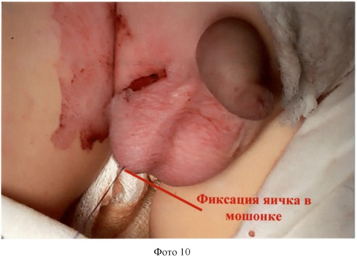 Способ низведения яичка при абдоминальной ретенции после пересечения тестикулярных сосудов (патент 2498780)