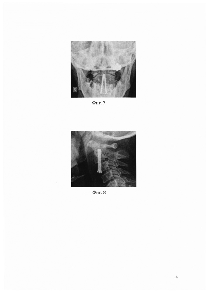 Способ лечения повреждений с2 позвонка (патент 2641160)