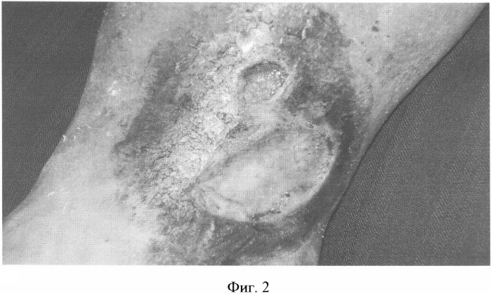 Способ лечения трофических язв нижних конечностей при посттромботической болезни (патент 2328288)