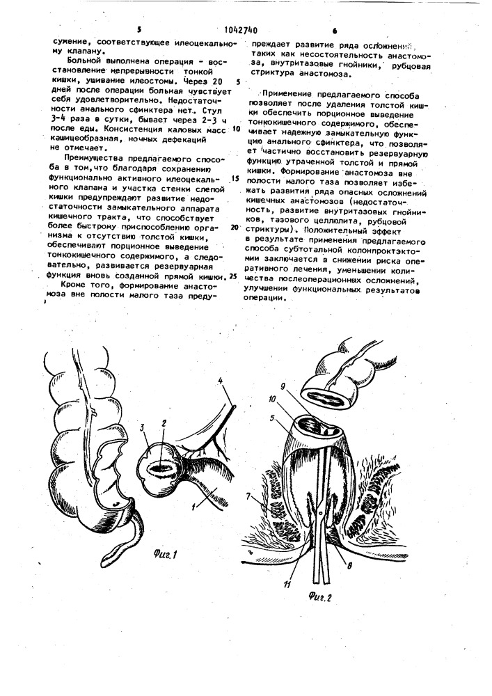 Способ колонпроктэктомии (патент 1042740)