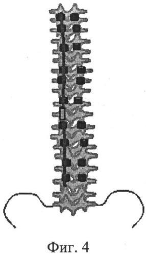 Способ коррекции деформации позвоночника (патент 2506919)