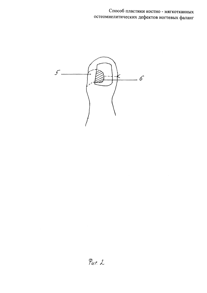 Способ пластики костно-мягкотканных остеомиелитических дефектов ногтевых фаланг (патент 2634421)