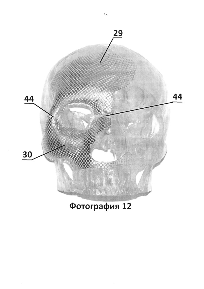 Имплантат для протезирования костей черепа и способ изготовления имплантата для протезирования костей черепа (патент 2638894)