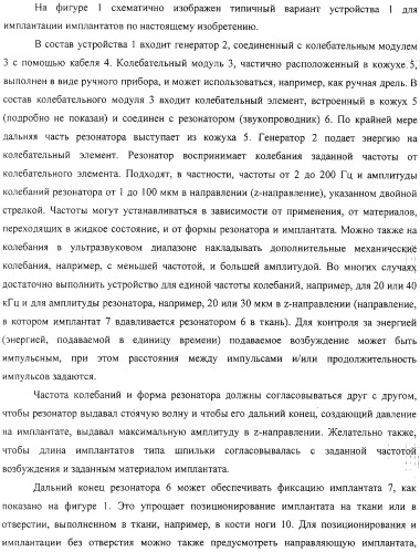 Имплантаты для создания соединений с тканями, в частности со скелетом, а также устройство и способ имплантации (патент 2314768)