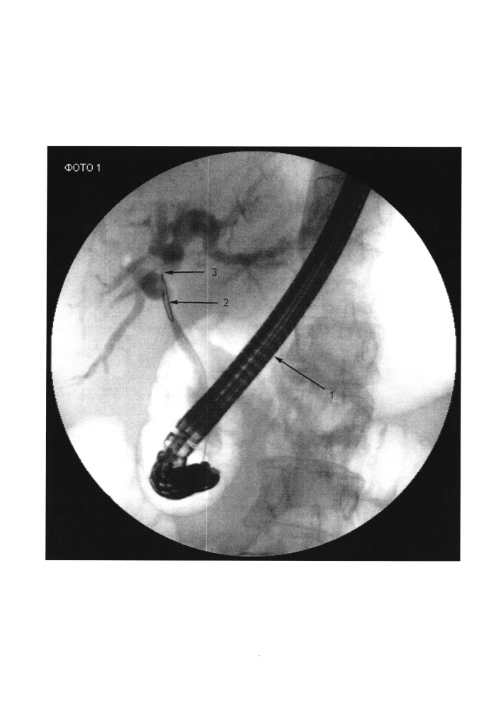 Способ эндоскопического бужирования рубцовых стриктур холедоха с применением перорального холедохоскопа (патент 2618207)