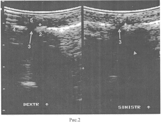 Способ ультразвуковой диагностики стадий болезни фрейберга (патент 2537891)