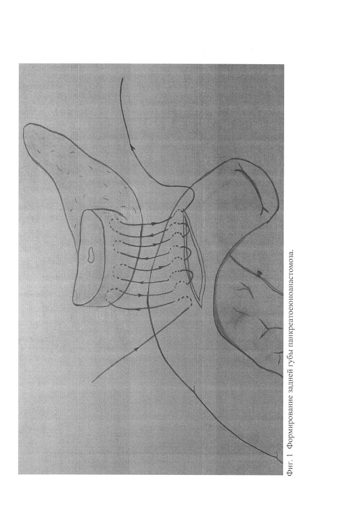 Способ формирования погружного кисетного инвагинационного панкреатоеюноанастомоза (патент 2665972)