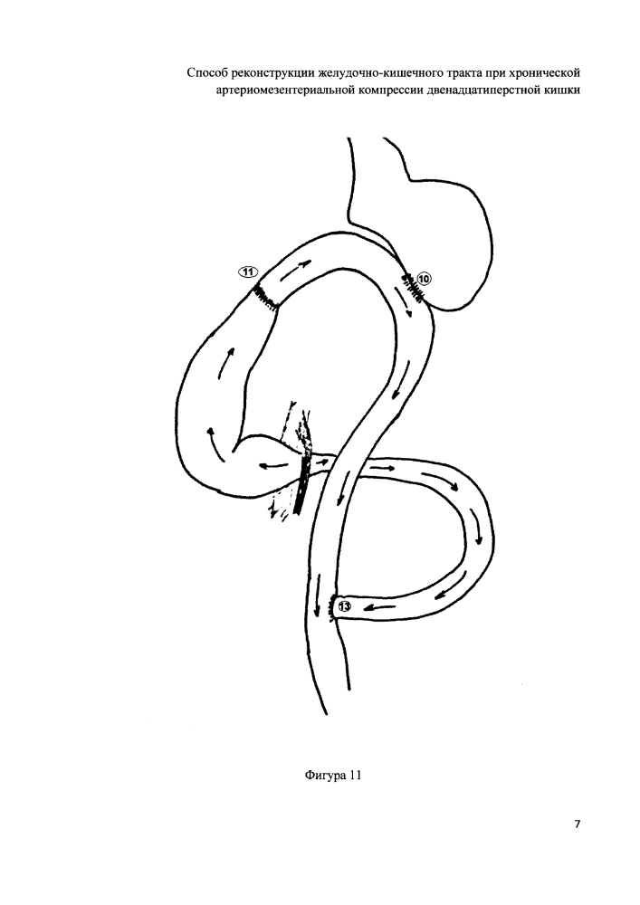 Способ реконструкции желудочно-кишечного тракта при хронической артериомезентериальной компрессии двенадцатиперстной кишки (патент 2607512)