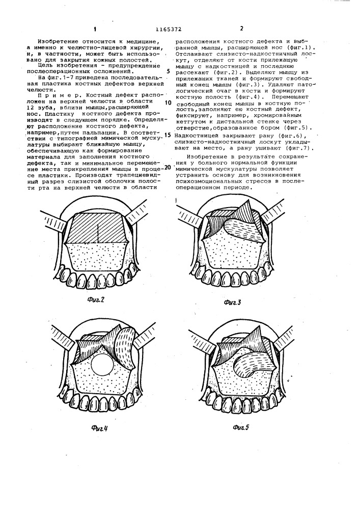 Способ пластики костных дефектов челюстей (патент 1165372)