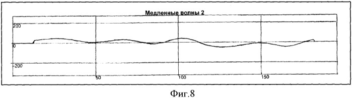 Способ определения типа демпинг-реакции при демпинг-синдроме (патент 2334456)