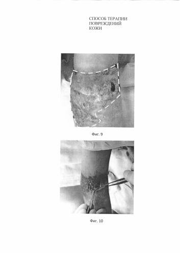 Способ терапии повреждений кожи и биотрансплантат для его осуществления (патент 2588835)
