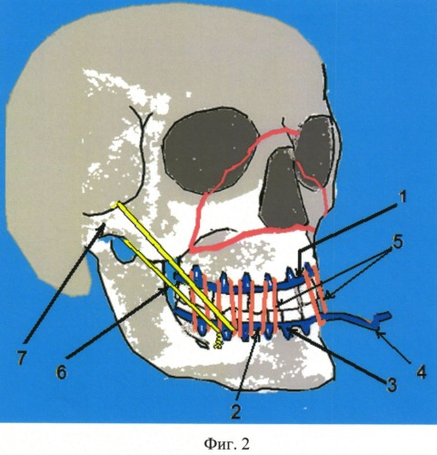 Устройство для лечения переломов средней зоны лица и способ его применения (патент 2546930)