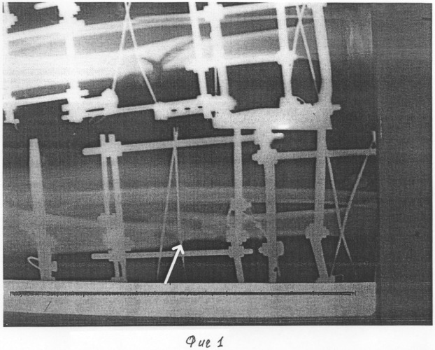 Способ лечения переломов длинных трубчатых костей (патент 2311155)