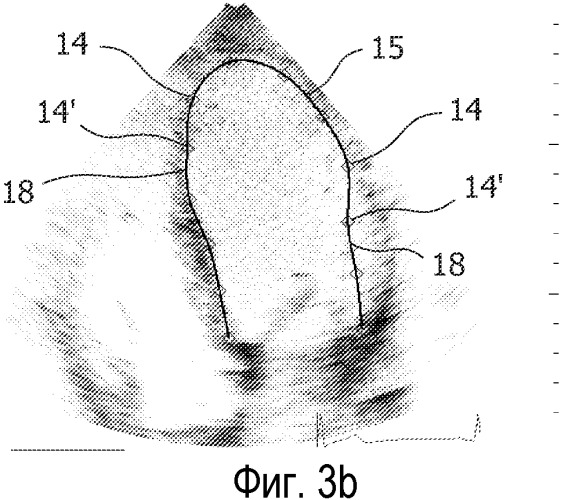 Ультразвуковая оценка сердечной синхронности и жизнеспособности (патент 2508055)