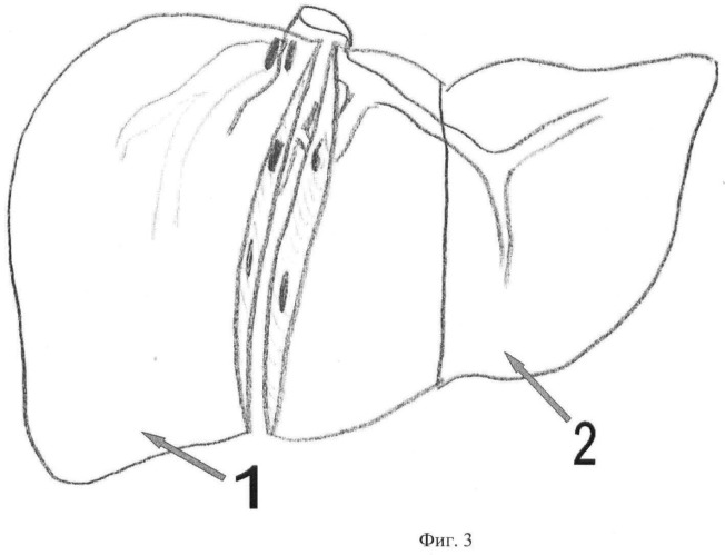 Способ левосторонней гемигепатэктомии (патент 2464941)