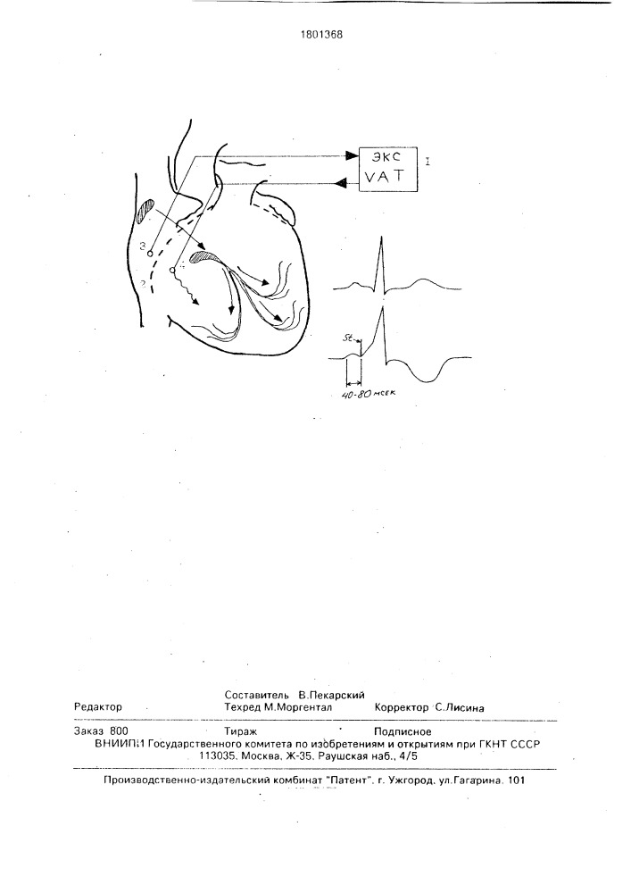Способ интраоперационной топической диагностики атриовентрикулярного дополнительного пути проведения при синдроме вольфа-паркинсона-уайта (патент 1801368)