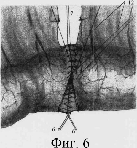 Способ восстановления непрерывности одноименных отделов кишки (патент 2328229)