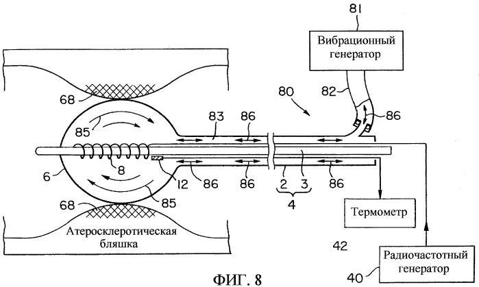 Радиочастотный термический баллонный катетер (патент 2244523)