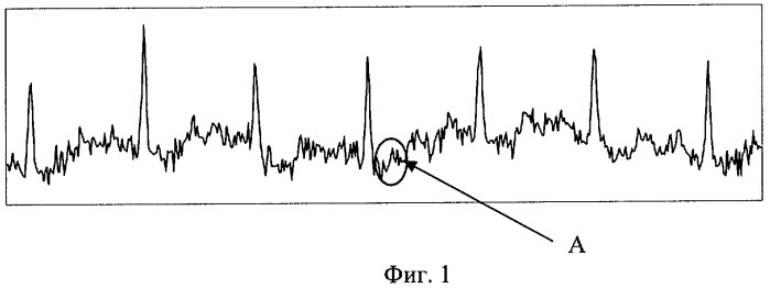 Способ представления электрокардиосигнала (патент 2427314)