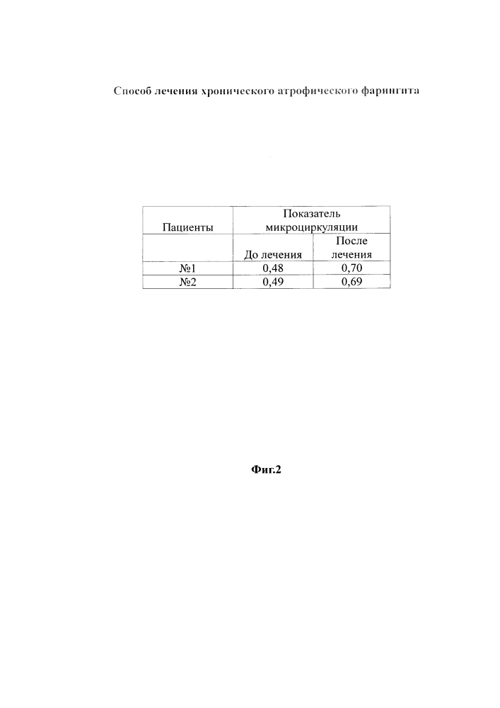 Способ лечения хронического атрофического фарингита (патент 2613186)