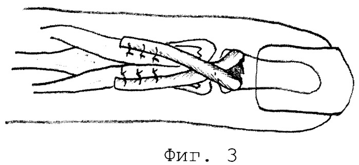 Способ аутопластики сухожилия дистального разгибателя пальца кисти (патент 2353319)