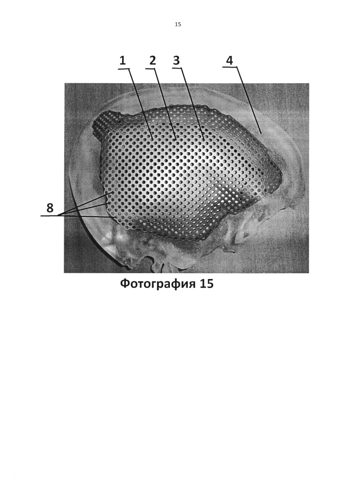 Имплантат для протезирования костей черепа и способ изготовления имплантата для протезирования костей черепа (патент 2638894)