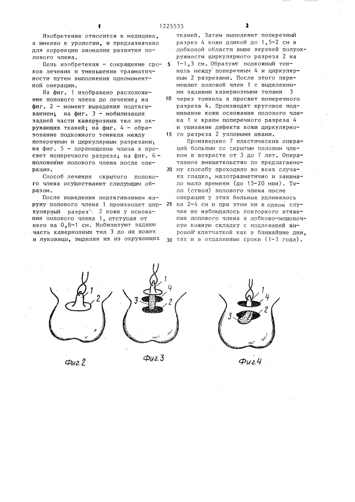 Способ лечения скрытого полового члена (патент 1225535)