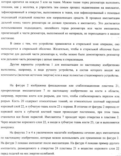 Имплантаты для создания соединений с тканями, в частности со скелетом, а также устройство и способ имплантации (патент 2314768)