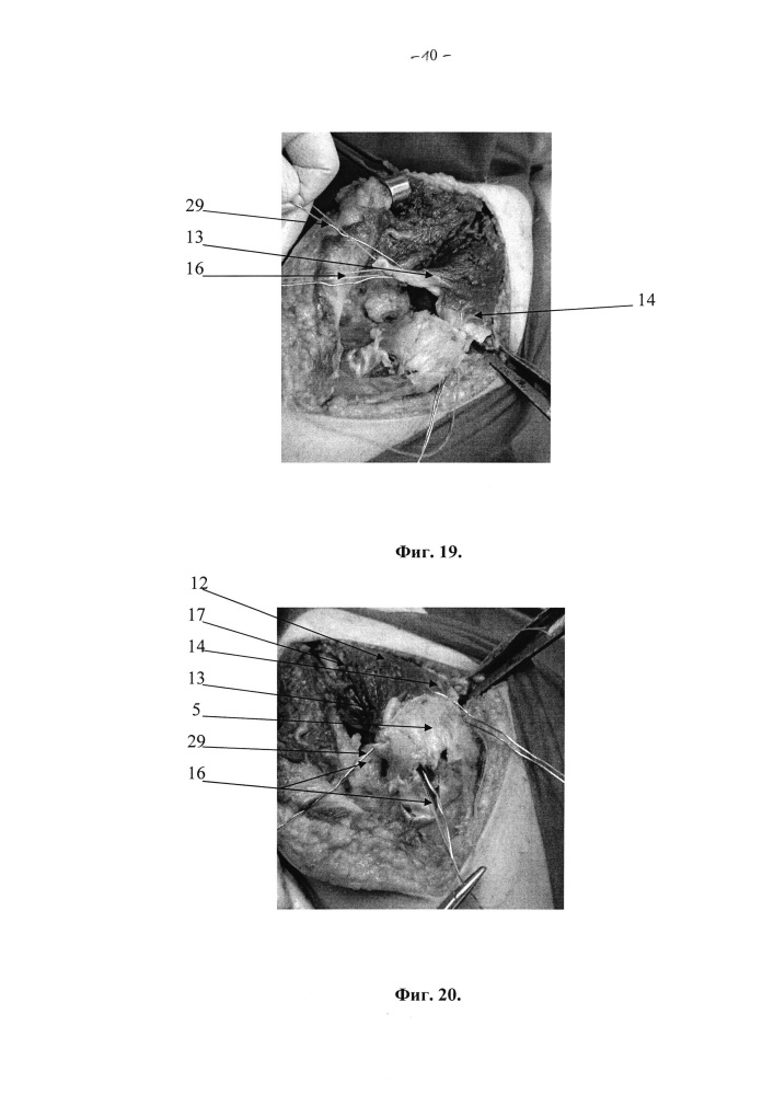 Способ экспериментального хирургического доступа к тазобедренному суставу при переломах вертлужной впадины (патент 2654008)