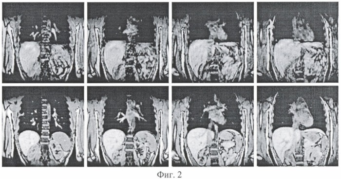 Способ исследования органов грудной и/или брюшной полости методом магнитно-резонансной томографии (патент 2355305)