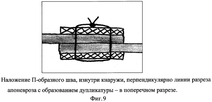 Способ ушивания апоневроза (патент 2277384)